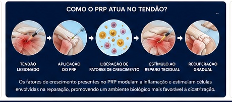 Esquema simplificado mostrando tendão lesionado, aplicação de PRP e recuperação gradual