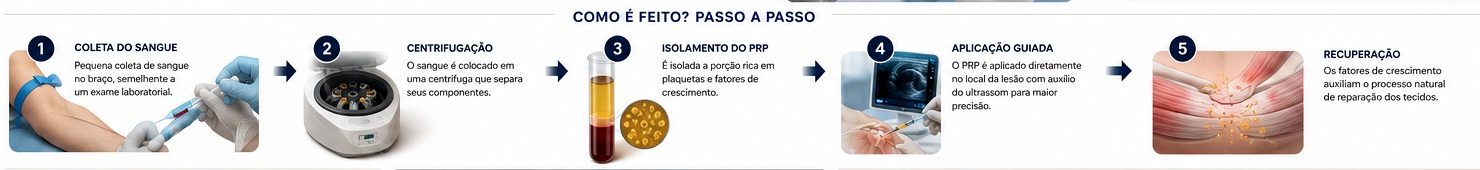 Passo a passo do PRP: coleta, centrifugação, obtenção do plasma rico em plaquetas e aplicação guiada